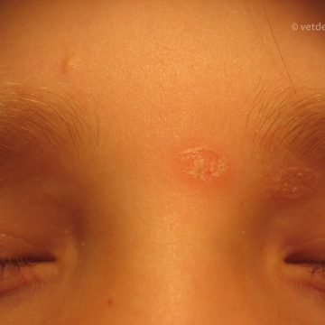 Dermatofütoos kassi omanikul